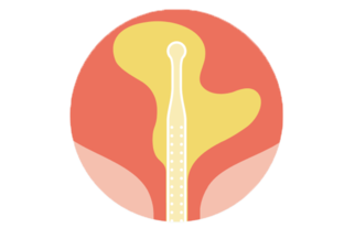 Complete bladder emptying