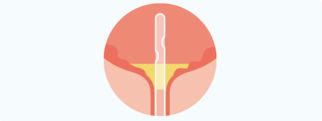 Learn more about residual urine